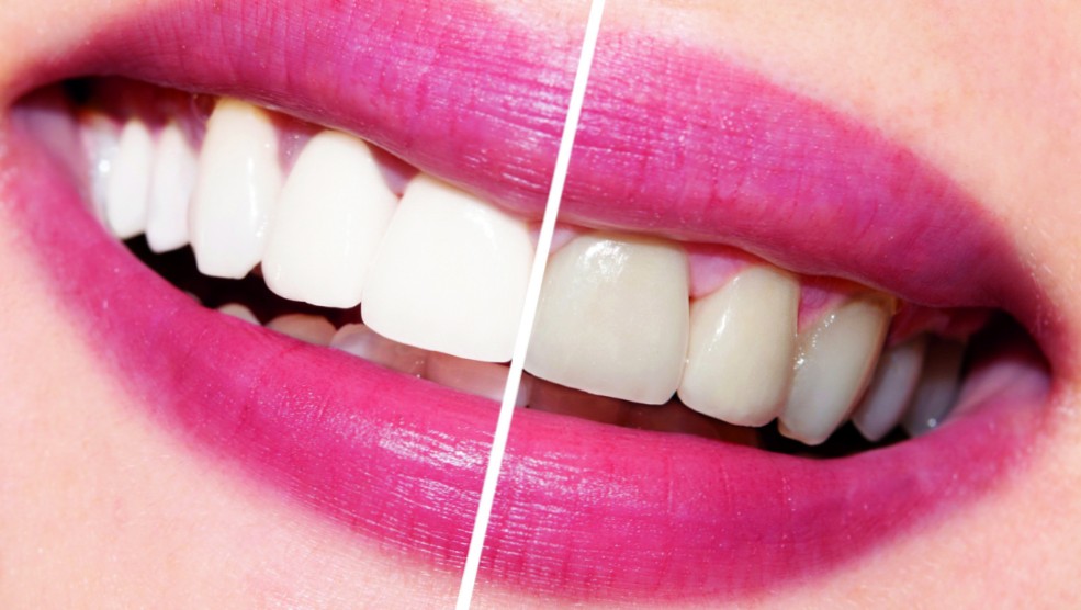 Как сделать зубы белыми?